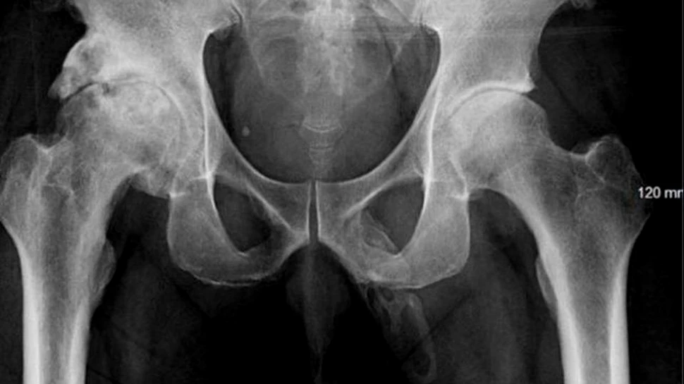 Caz medical bizar: penisul unui bărbat se transformă în os