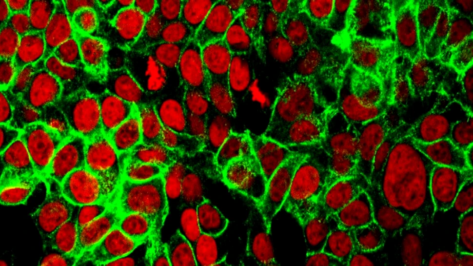 Un medicament împotriva depresiei poate fi folosit pentru a trata „cancerul copilăriei”