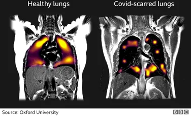 Leziuni pulmonare „ascunse” cauzate de COVID-19, identificate printr-o nouă metodă de imagistică