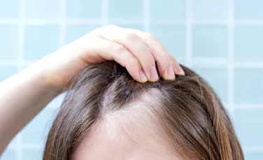 Un medicament comun pentru artrită ar putea stimula regenerarea părului la pacienții cu alopecie