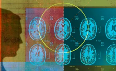 Un algoritm de inteligenţă artificială identifică tumorile cerebrale cu precizia unui specialist