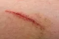 Pielea bioimprimată vindecă rănile severe la porci. Va funcționa și la oameni?