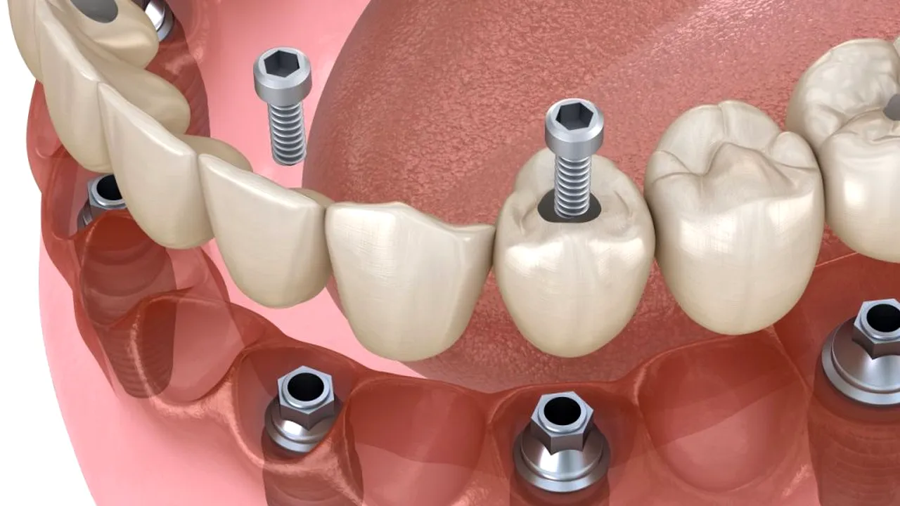 implant dentar suprafete_shutterstock_1727881339_descopera 