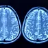 Depresia ar putea afecta capacitatea creierului de a genera noi neuroni