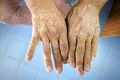 Primul transplant dublu de mâini pentru un pacient cu sclerodermie. Care este starea sa acum?