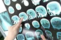 Un nou studiu identifică două proteine care pot contribui la recidiva accidentului vascular cerebral