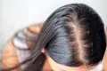 Un medicament care ar putea trata pierderea părului, tot mai aproape de realitate