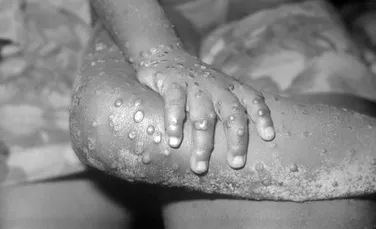 Epidemia de variola maimuţei, „cea mai mare din istorie” în Europa