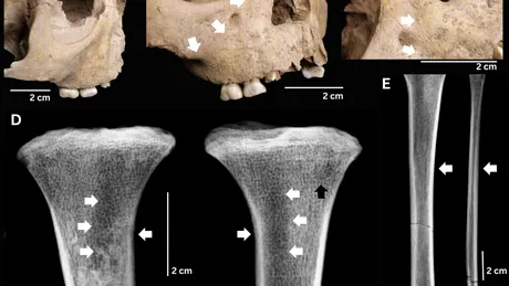 Dinții copiilor antici dezvăluie o boală extrem de gravă de acum 4.000 de ani