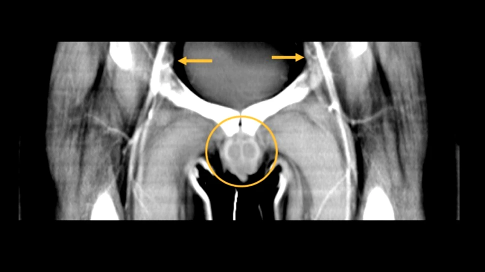 Primul transplant de penis din lume s-a dovedit un succes. Bărbatul se simte ”întreg din nou”