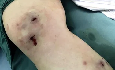 O femeie a trecut prin clipe îngrozitoare când un vierme a ieşit din genunchiul acesteia după o călătorie în Brazilia – FOTO