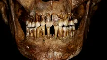 O femeie aristocrată din secolul al XVII-lea își lega dinții cu sârmă de aur, au descoperit cercetătorii