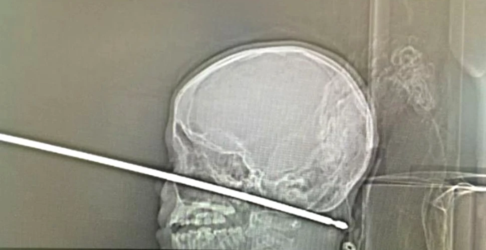 Un băiat a supravieţuit miraculos după ce a căzut cu capul într-o tijă metalică