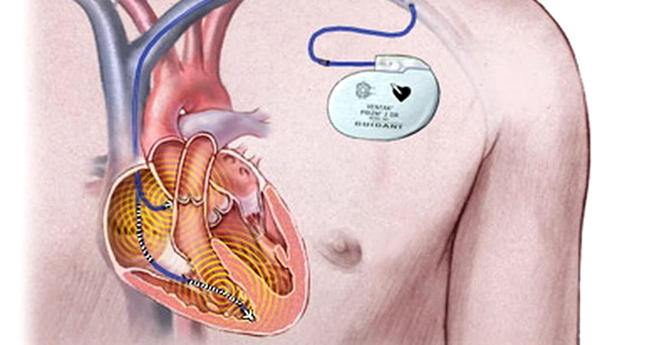 Pacemakerele si defibrilatoarele cardiace, vulnerabile la pirateria informatica