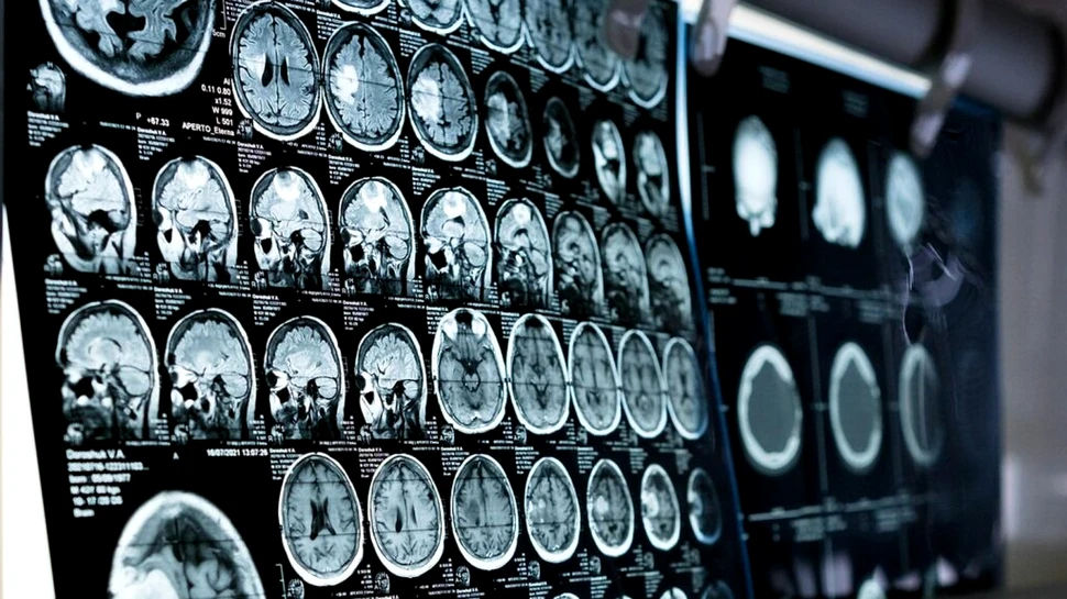 Cercetătorii au identificat, în premieră, genele specifice implicate în schizofrenie