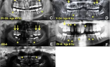A fost descoperită cauza pentru o mutație genetică misterioasă