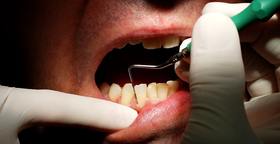 TREBUIE sau NU să ne lipsim de molarii de minte? Cercetătorii din domeniul sănătaţii orale distrug cel mai mare mit