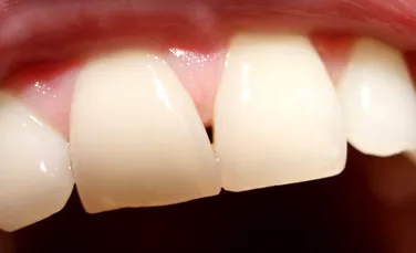 Dinţi mai albi, mai rezistenţi şi mai puţin sensibili la durere: un nou material promite o adevărată revoluţie în stomatologie