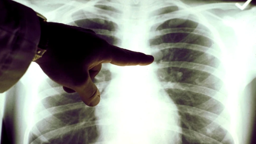 Patru studenţi români au creat un sistem care analizează radiografii cu ajutorul inteligenţei artificiale