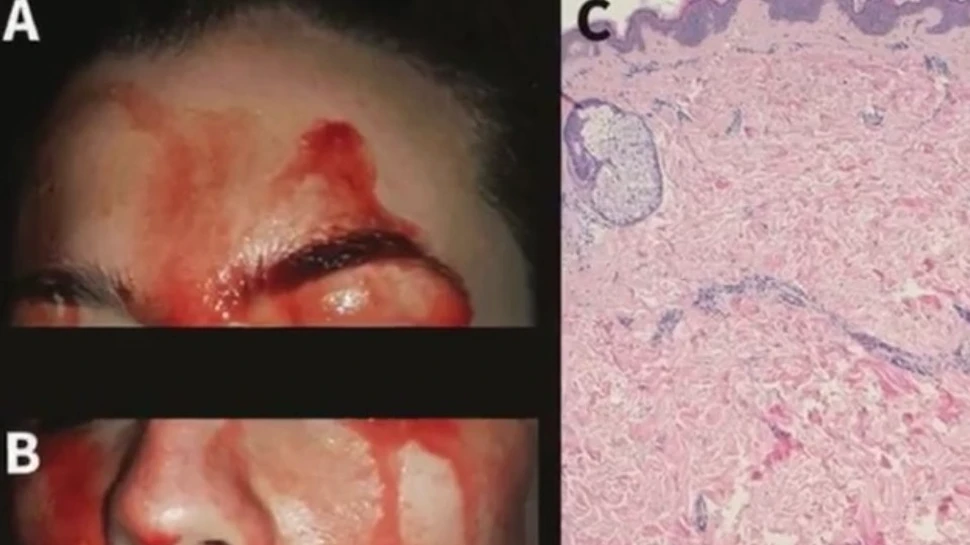 Cazul medical extrem de rar care i-a şocat chiar şi pe medicii experimentaţi: o femeie transpiră sânge