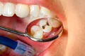 Mai bine de jumătate dintre copii și adulții din România au carii dentare