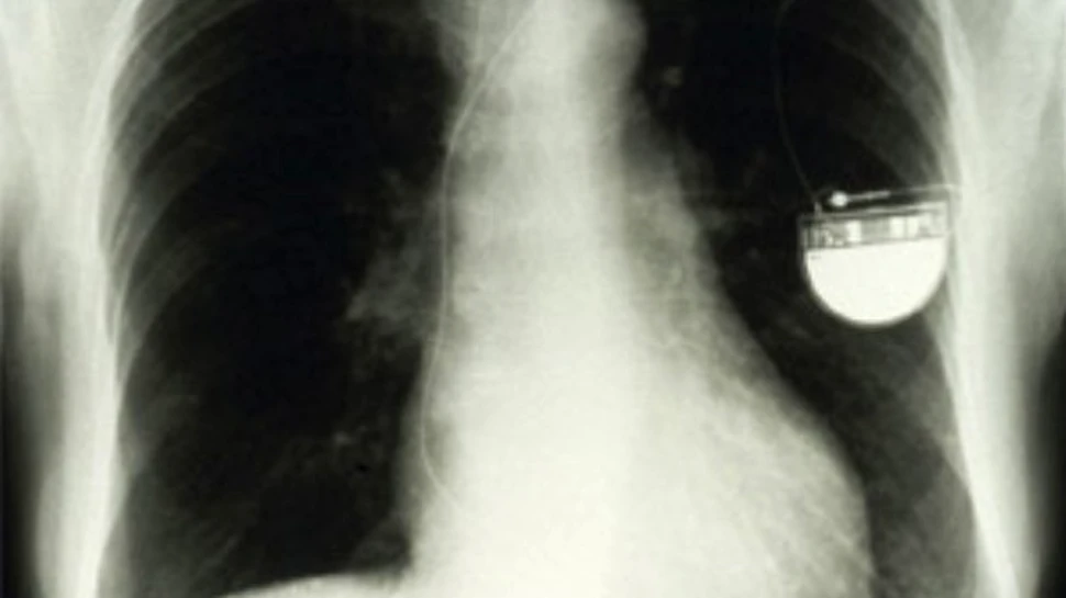 A fost implantat pacemakerul care comunica wireless