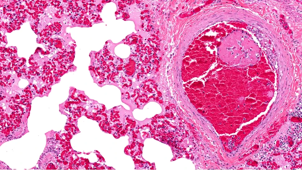 Modificările din sânge, nu ale inimii, ar putea sta la baza trombozei cardiace la pacienții cu COVID-19