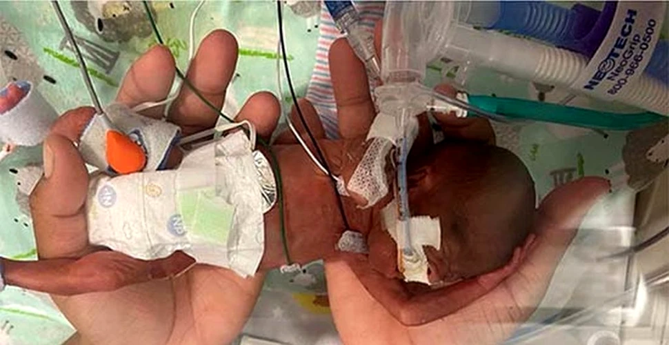 Un bebeluș născut prematur, cu o șansă de supraviețuire mai mică de 1%, a intrat în Cartea Recordurilor
