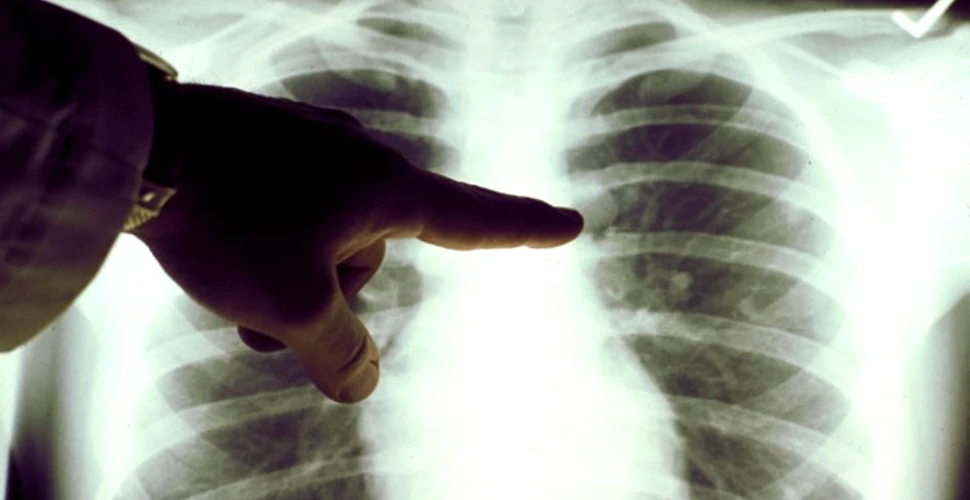 Principala cauză de mortalitate în rândul bărbaţilor este cancerul pulmonar