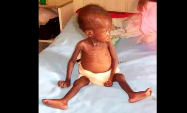 Generaţia malnutrită: 300 de copii mor în fiecare oră din cauza foametei