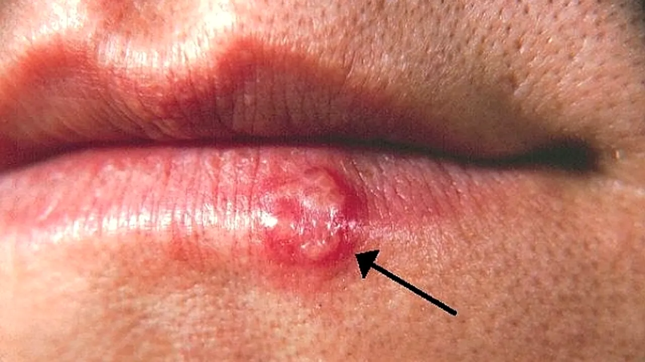 1-herpes 