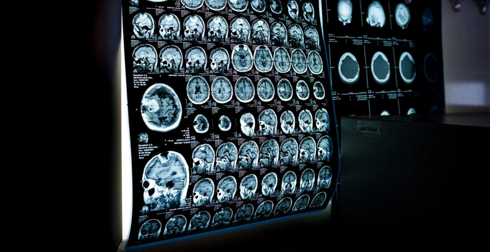 COVID-19 declanșează anomalii ale creierului, chiar și la 6 luni după recuperare