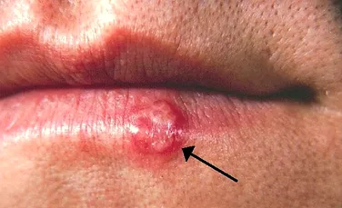 Ai fost afectat vreodată de herpesul oral? Cercetătorii au identificat un nou risc asociat acestui virus!