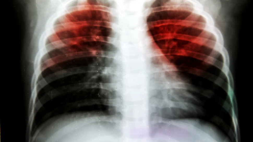 Un test ar putea identifica milioane de oameni care răspândesc tuberculoza fără să știe