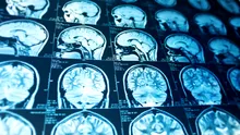 O creștere alarmantă de abcese cerebrale a fost observată la copii