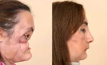 Primul transplant facial din Statele Unite a fost dezvaluit