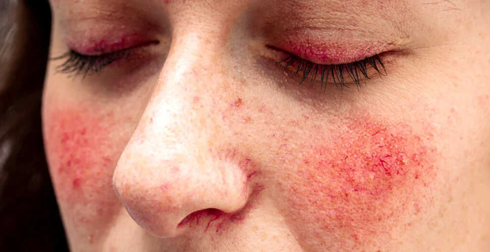 Cancerul de piele, „mascat” de unele boli dermatologice comune