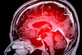 Microbiomul creierului ar putea ajuta la prevenirea demenței?