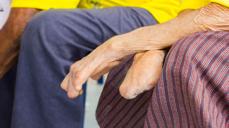 Un nou studiu rescrie tot ce se ştia despre lepră, plaga menţionată şi în Biblie care încă mutilează popoare