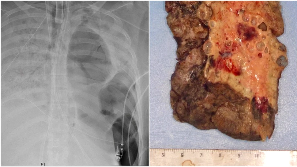 Dublu transplant de plămâni pentru o tânără grav afectată de COVID-19. Este o premieră pentru SUA