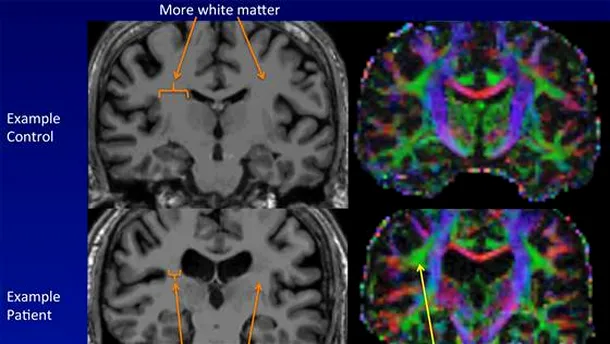Creierul unei persoane sănătoase (sus) în comparaţie cu al unui bolnav (jos)