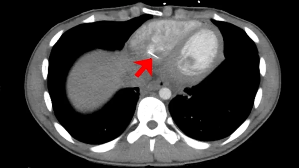 Caz medical neobișnuit. Un adolescent s-a prezentat la spital din cauza unui ac de croitorie care i-a intrat în inimă