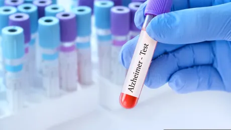 Un test simplu de sânge ar putea depista Alzheimer înainte de pierderea memoriei