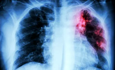Inteligența Artificială a creat un nou medicament pentru fibroza pulmonară