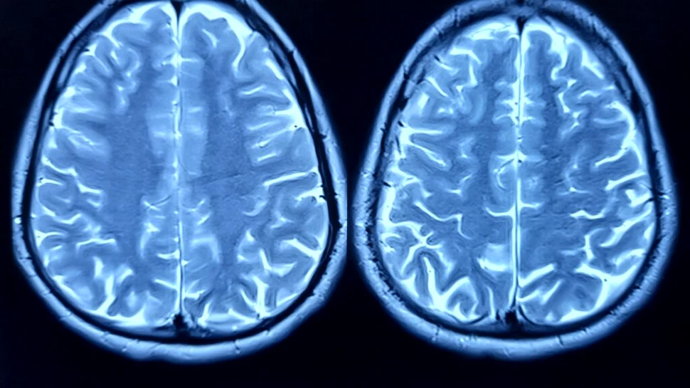 Celule cerebrale umane conectate la cipuri au jucat Doom, într-un experiment mai puțin obișnuit