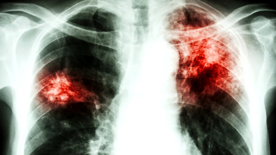Tuberculoza, diagnosticată în doar două ore în Bucureşti şi Bisericani-Neamţ. Până acum dura 4-6 luni