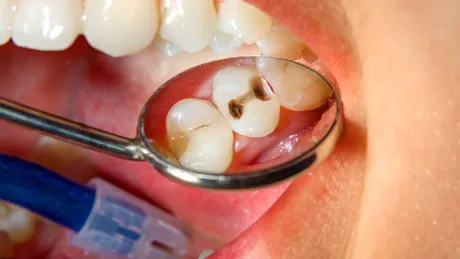 Mai bine de jumătate dintre copii și adulții din România au carii dentare