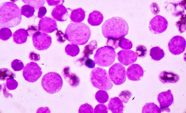 Formele agresive de cancer ar putea fi oprite de un vaccin experimental