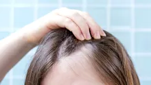 Un medicament comun pentru artrită ar putea stimula regenerarea părului la pacienții cu alopecie