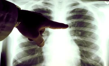 Celulele cancerului pulmonar, distruse în proporţie de 80% cu ajutorul unor nanoparticule derivate din frunzele de ceai